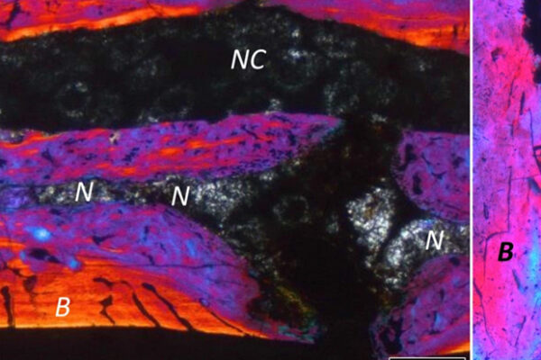 intervertebral disc 1